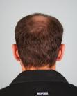 Before Hair Transplant&nbsp;Midscalp